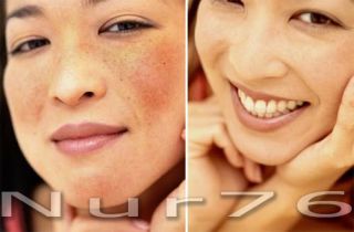 NUR76 Skin Lightening Cream Whitening Serum Face Acne